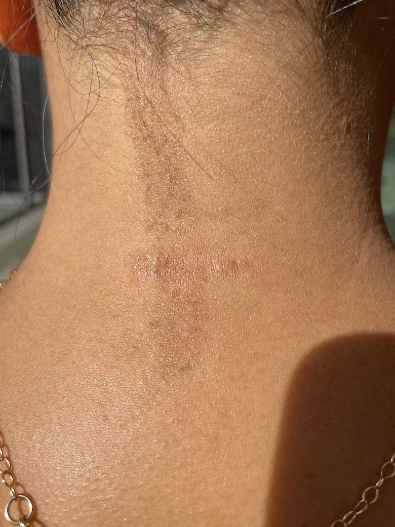 Neck Keloid Scars with Kenalog steroid injection treatment - October 11, 2021